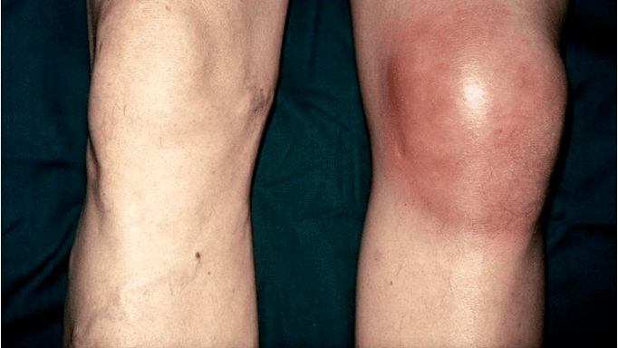 Artrosis y artritis