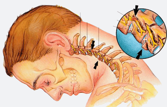 Etapas de la osteocondrosis de la columna cervical